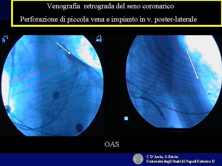 Venografia retrograda del seno coronarico Perforazione di piccola vena e impianto in v. poster-laterale