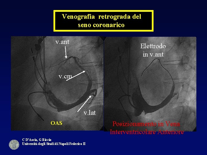 Venografia retrograda del seno coronarico v. ant Elettrodo in v. ant v. cm v.