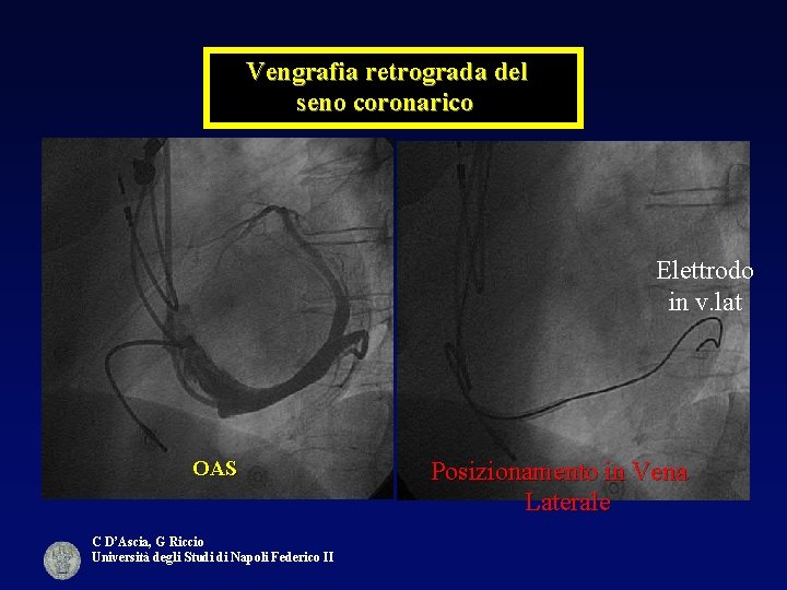 Vengrafia retrograda del seno coronarico Elettrodo in v. lat OAS C D’Ascia, G Riccio