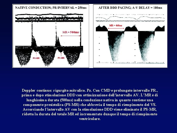 Doppler continuo: rigurgito mitralico. Pz. Con CMD e prolungato intervallo PR. , prima e