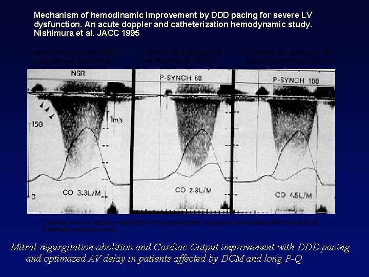 Mechanism of hemodinamic improvement by DDD pacing for severe LV dysfunction. An acute doppler