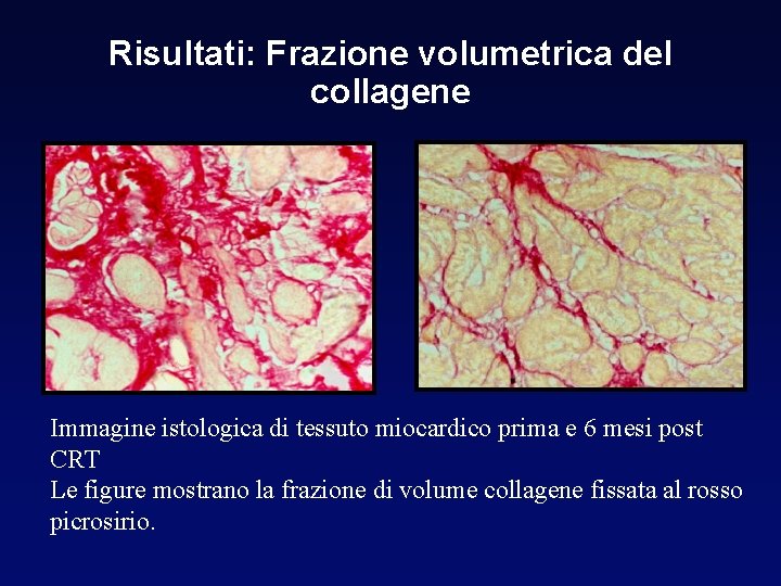 Risultati: Frazione volumetrica del collagene Immagine istologica di tessuto miocardico prima e 6 mesi