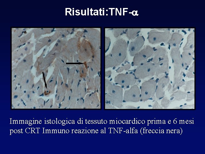 Risultati: TNF- Immagine istologica di tessuto miocardico prima e 6 mesi post CRT Immuno