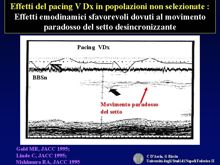 Effetti del pacing V Dx in popolazioni non selezionate : Effetti emodinamici sfavorevoli dovuti