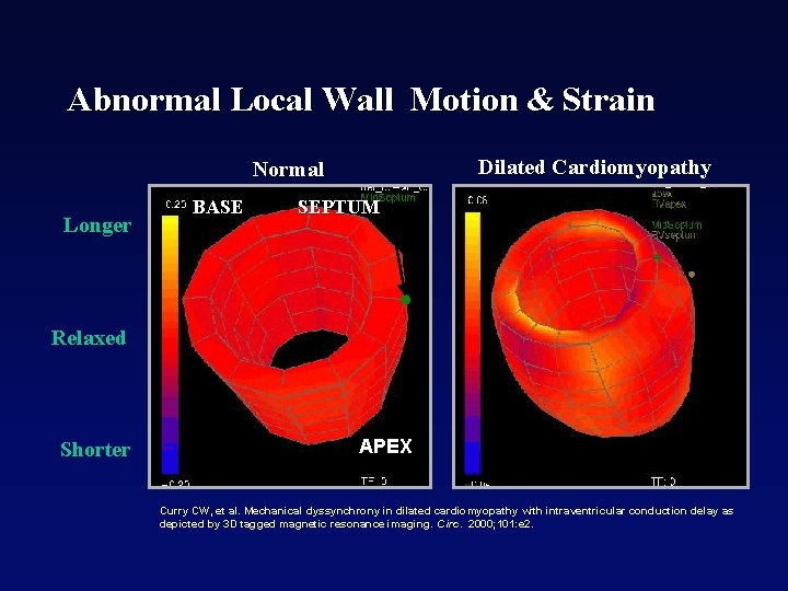 Abnormal Local Wall Motion & Strain Dilated Cardiomyopathy Normal Longer BASE SEPTUM Relaxed Shorter