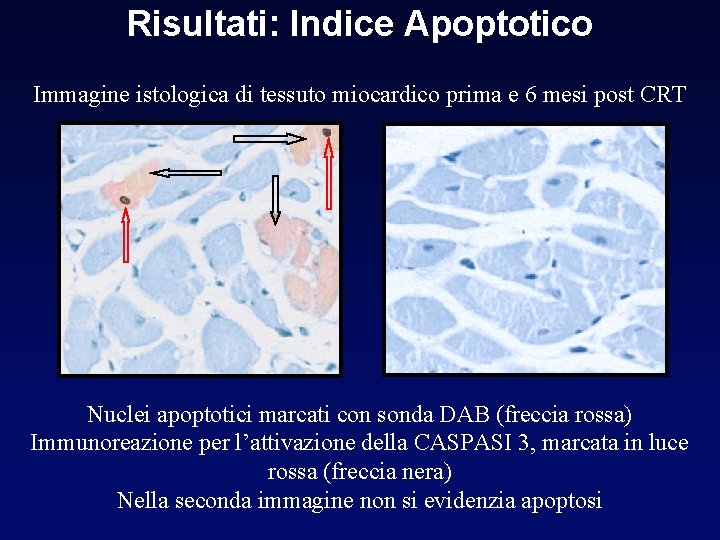 Risultati: Indice Apoptotico Immagine istologica di tessuto miocardico prima e 6 mesi post CRT