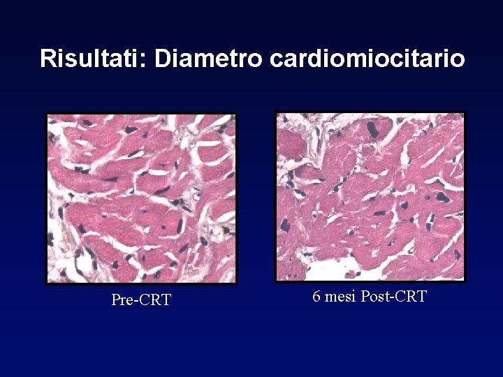 Risultati: Diametro cardiomiocitario Pre-CRT 6 mesi Post-CRT 
