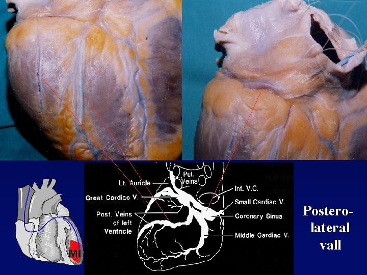 Posterolateral vall 