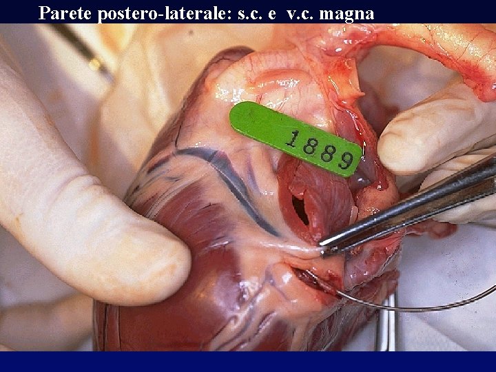 Parete postero-laterale: s. c. e v. c. magna 