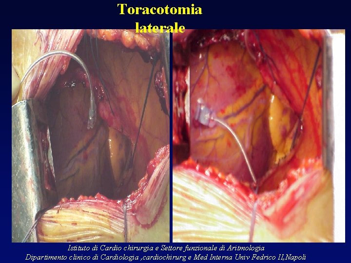 Toracotomia laterale Istituto di Cardio chirurgia e Settore funzionale di Aritmologia Dipartimento clinico di