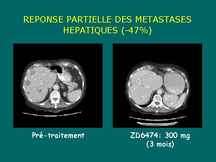 REPONSE PARTIELLE DES METASTASES HEPATIQUES (-47%) Pré-traitement ZD 6474: 300 mg (3 mois) 