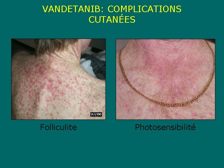 VANDETANIB: COMPLICATIONS CUTANÉES Folliculite Photosensibilité 