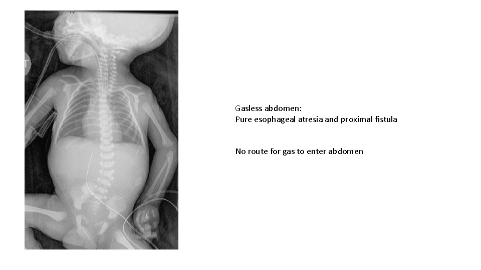 Gasless abdomen: Pure esophageal atresia and proximal fistula No route for gas to enter