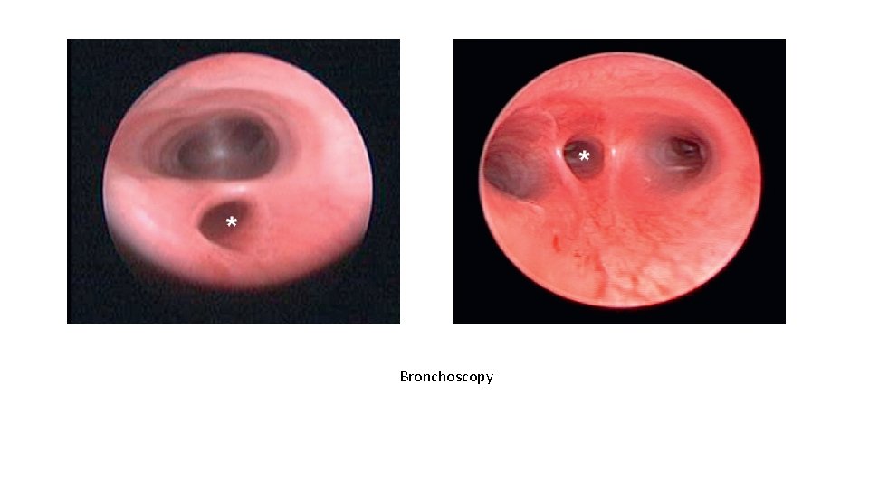 Bronchoscopy 