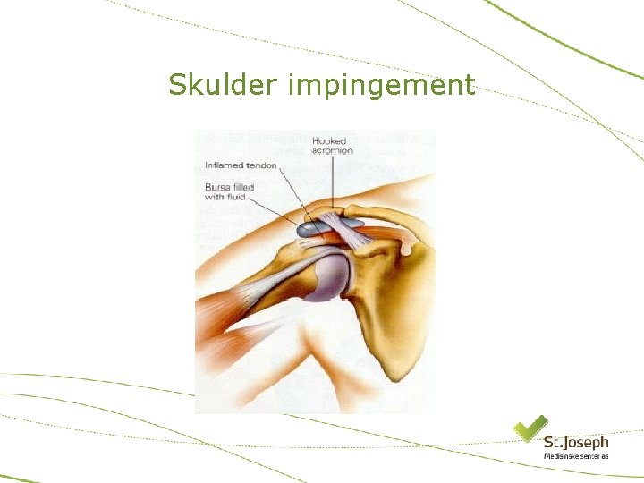 Skulder impingement 