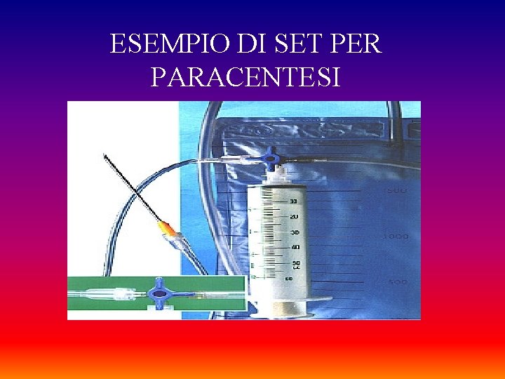 ESEMPIO DI SET PER PARACENTESI 