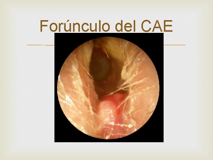 Forúnculo del CAE Forúnculo del CAE