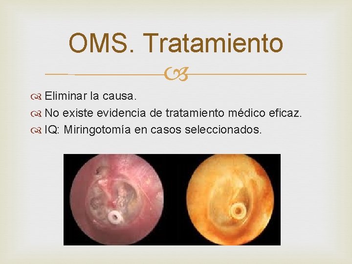 OMS. Tratamiento Eliminar la causa. No existe evidencia de tratamiento médico eficaz. IQ: Miringotomía OMS. Tratamiento Eliminar la causa. No existe evidencia de tratamiento médico eficaz. IQ: Miringotomía