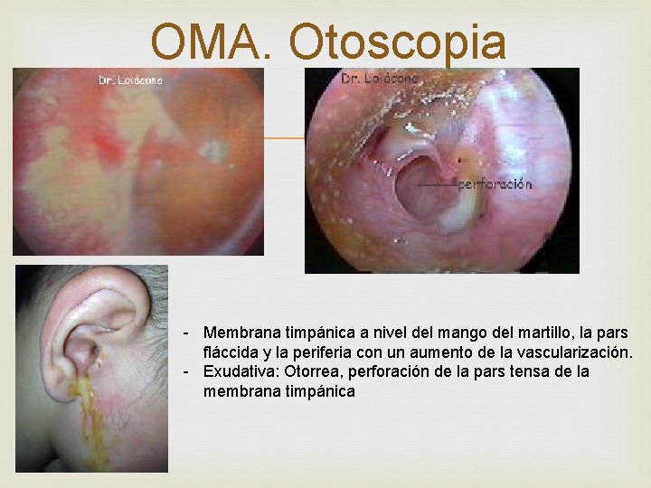 OMA. Otoscopia - Membrana timpánica a nivel del mango del martillo, la pars fláccida OMA. Otoscopia - Membrana timpánica a nivel del mango del martillo, la pars fláccida