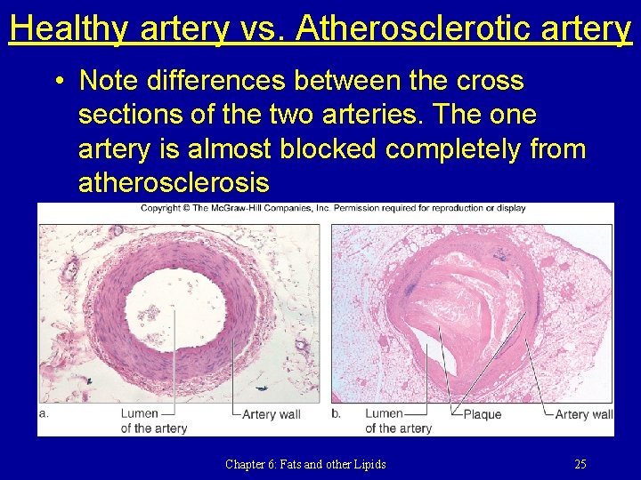 Healthy artery vs. Atherosclerotic artery • Note differences between the cross sections of the