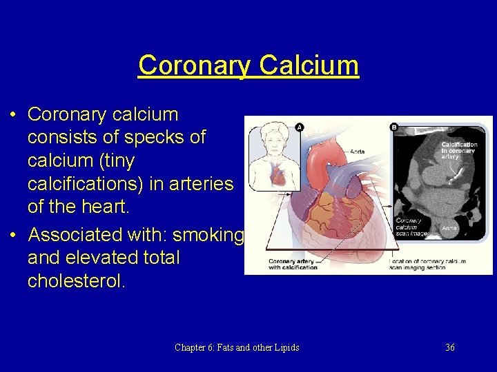 Coronary Calcium • Coronary calcium consists of specks of calcium (tiny calcifications) in arteries