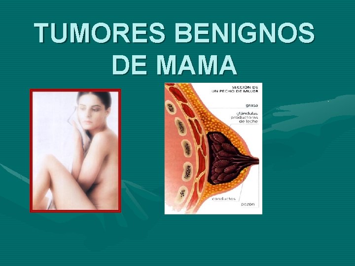 TUMORES BENIGNOS DE MAMA 