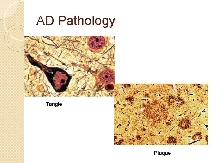 AD Pathology Tangle Plaque AD Pathology Tangle Plaque