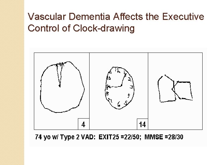 Vascular Dementia Affects the Executive Control of Clock-drawing Vascular Dementia Affects the Executive Control of Clock-drawing