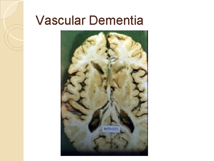 Vascular Dementia Vascular Dementia