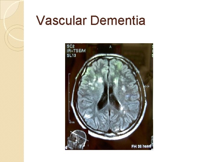 Vascular Dementia Vascular Dementia