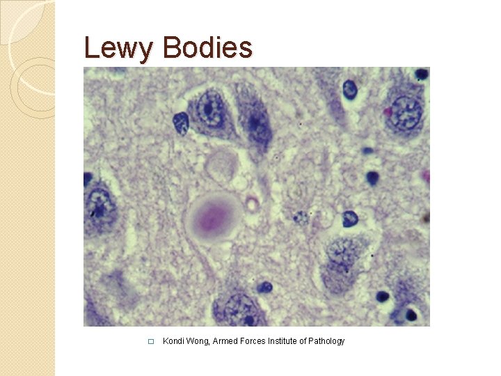 Lewy Bodies � Kondi Wong, Armed Forces Institute of Pathology Lewy Bodies � Kondi Wong, Armed Forces Institute of Pathology