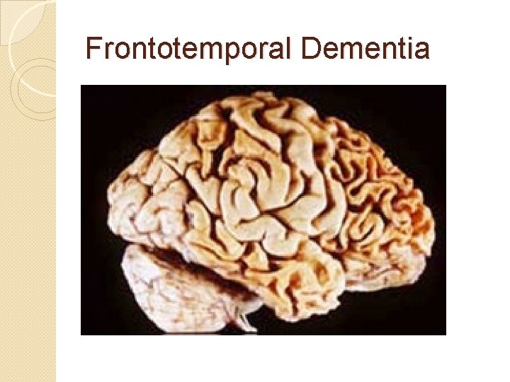 Frontotemporal Dementia Frontotemporal Dementia