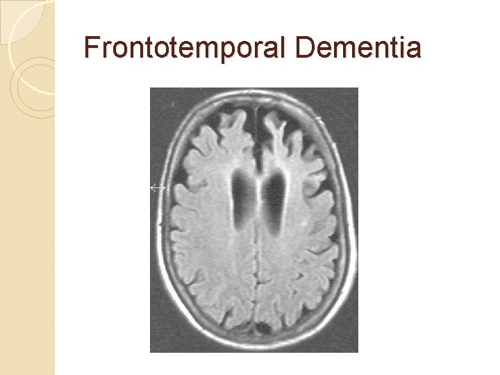 Frontotemporal Dementia Frontotemporal Dementia