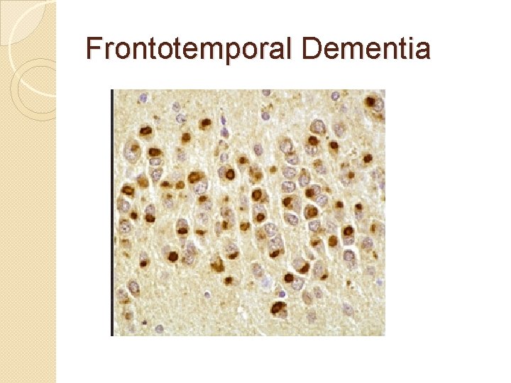 Frontotemporal Dementia Frontotemporal Dementia