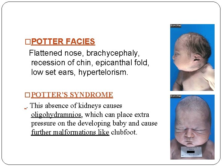 �POTTER FACIES Flattened nose, brachycephaly, recession of chin, epicanthal fold, low set ears, hypertelorism.