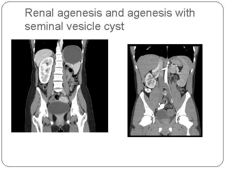 Renal agenesis and agenesis with seminal vesicle cyst 