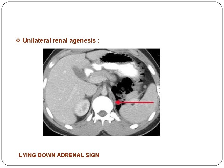 v Unilateral renal agenesis : • 1 in 1000 • Males / left kidney