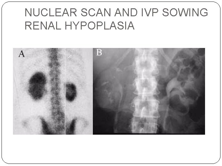 NUCLEAR SCAN AND IVP SOWING RENAL HYPOPLASIA 