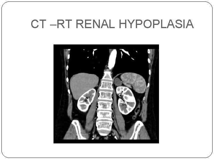 CT –RT RENAL HYPOPLASIA 