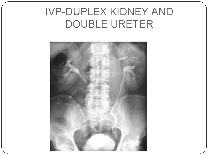 IVP-DUPLEX KIDNEY AND DOUBLE URETER 