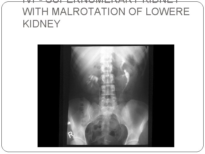 IVP- SUPERNUMERARY KIDNEY WITH MALROTATION OF LOWERE KIDNEY 