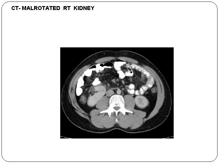 CT- MALROTATED RT KIDNEY If a kidney fails to rotate, the hilum faces anteriorly,