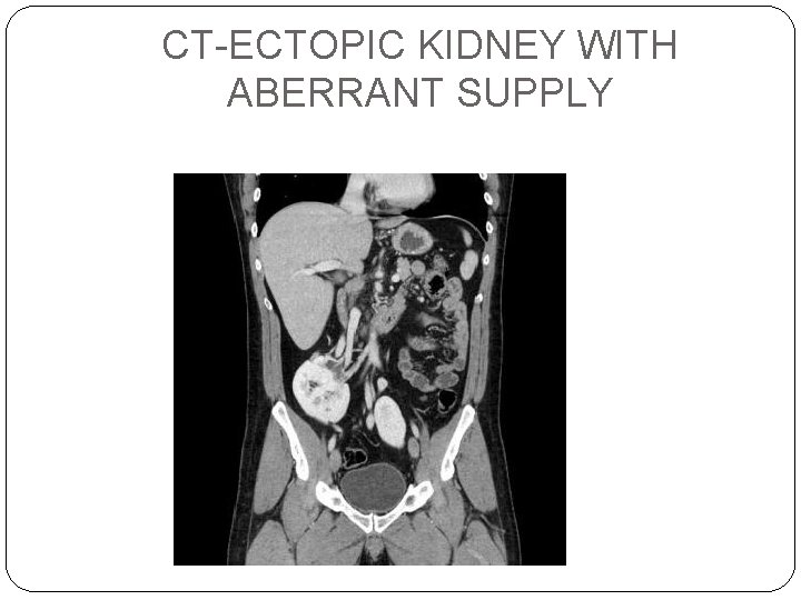 CT-ECTOPIC KIDNEY WITH ABERRANT SUPPLY 