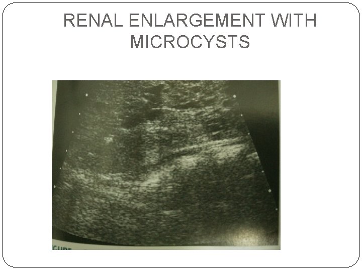 RENAL ENLARGEMENT WITH MICROCYSTS 