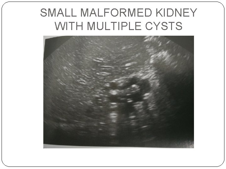 SMALL MALFORMED KIDNEY WITH MULTIPLE CYSTS 