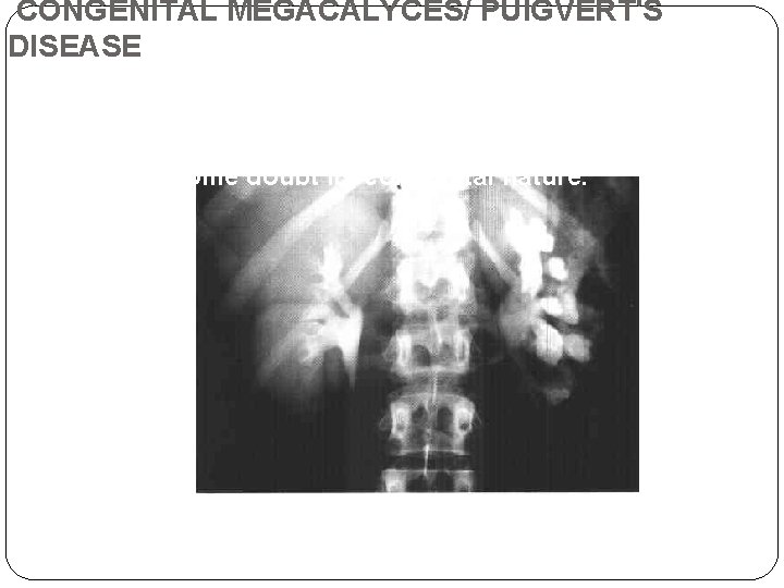 CONGENITAL MEGACALYCES/ PUIGVERT'S DISEASE Calyces are asymmetrically dilated. Renal pelvis is normal. Some doubt