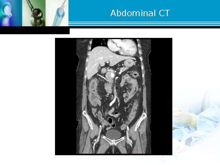 Abdominal CT Abdominal CT