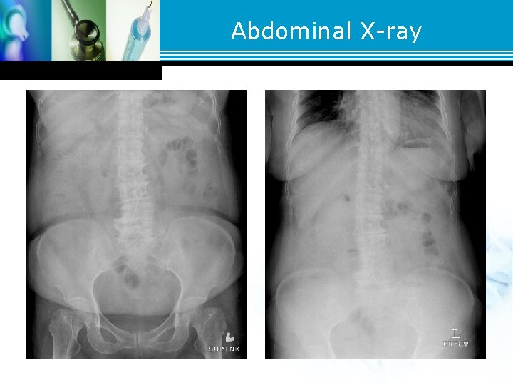 Abdominal X-ray Abdominal X-ray