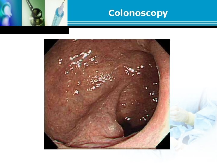 Colonoscopy Colonoscopy