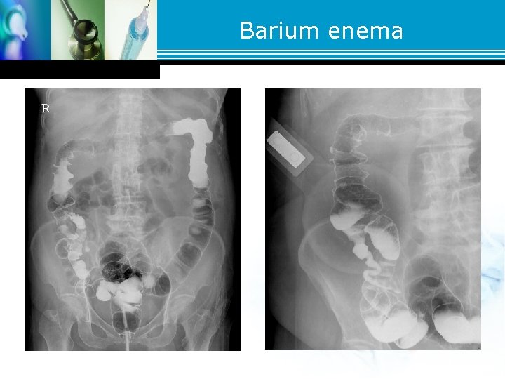 Barium enema Barium enema